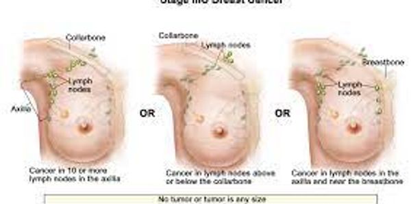 Stage 3 C breast cancer photos