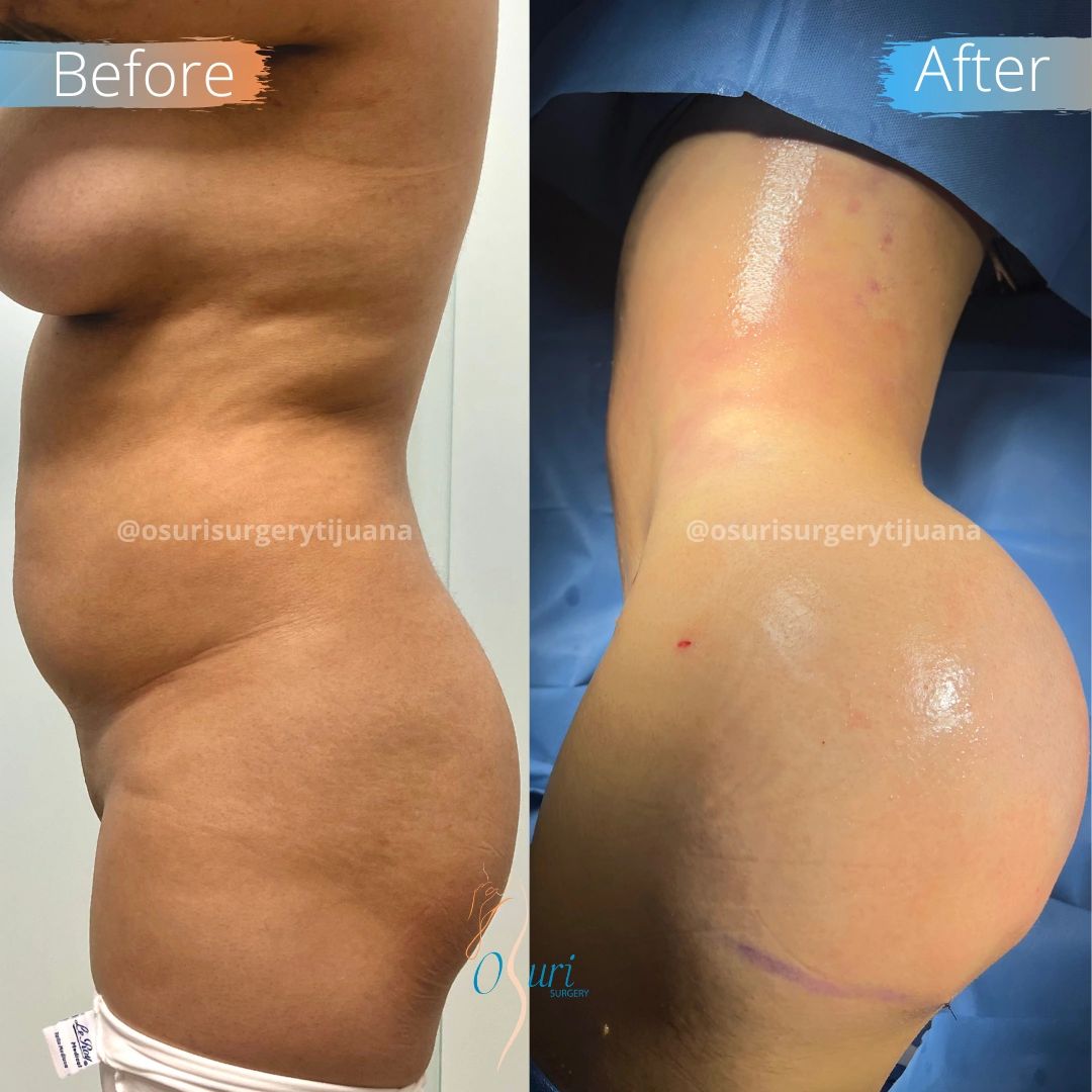 Buttock Transformation Before and After Surgery.