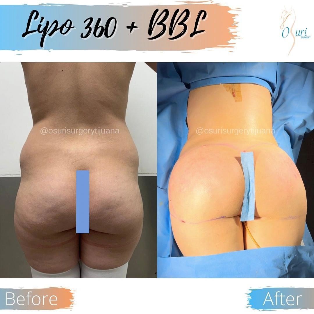 Before and After Lipo 360 and BBL Comparison Showing Waist and Buttock Contouring.