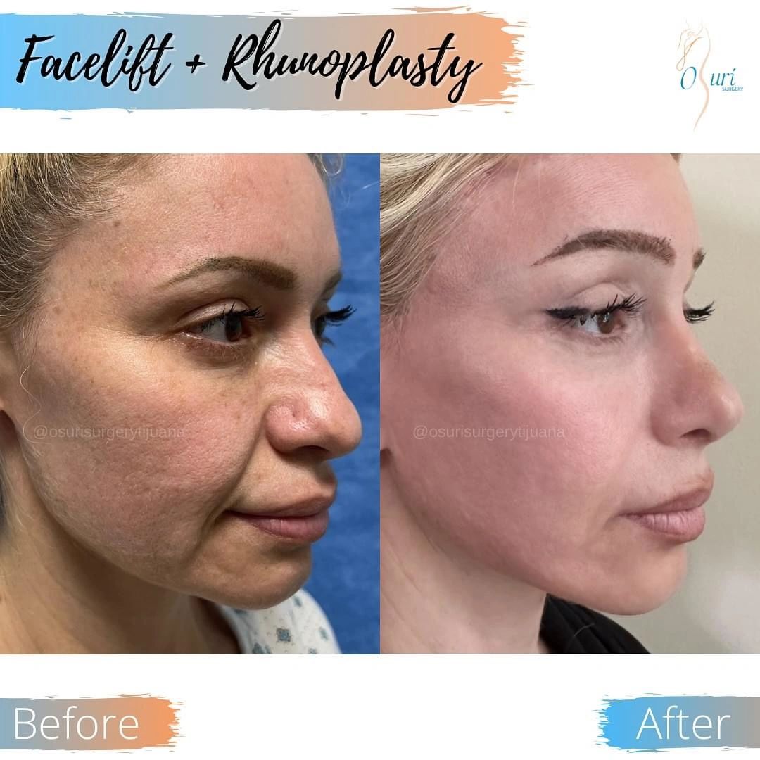 Before and After Rhinoplasty