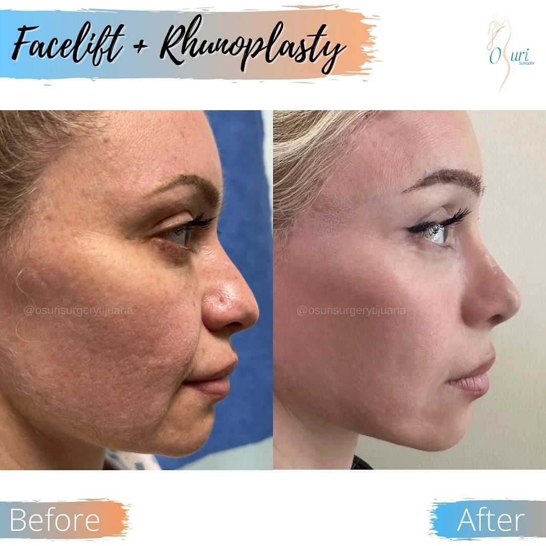 Facelift and rhinoplasty results showing smoother, firmer skin and a refined nasal profile.