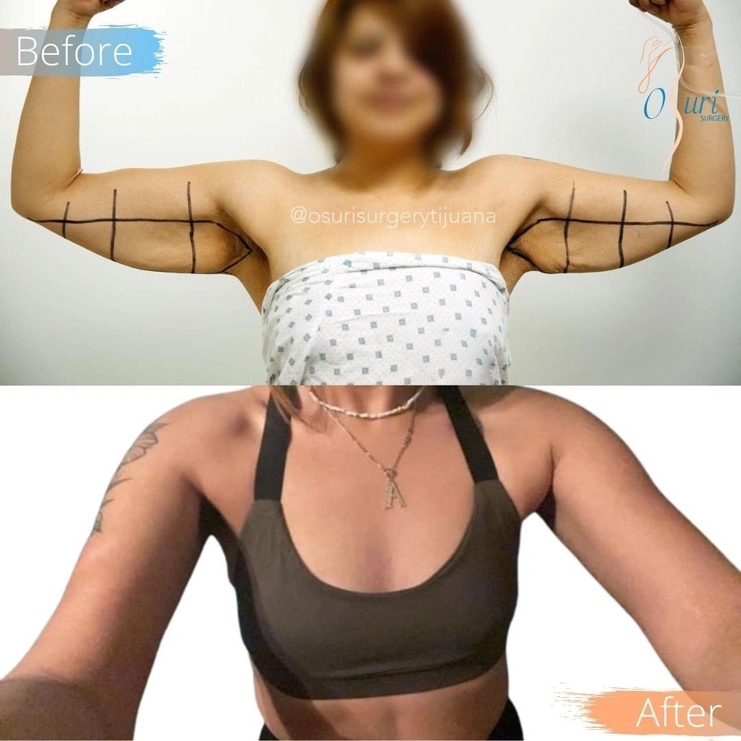 Comparación antes y después de una cirugía de brazos.