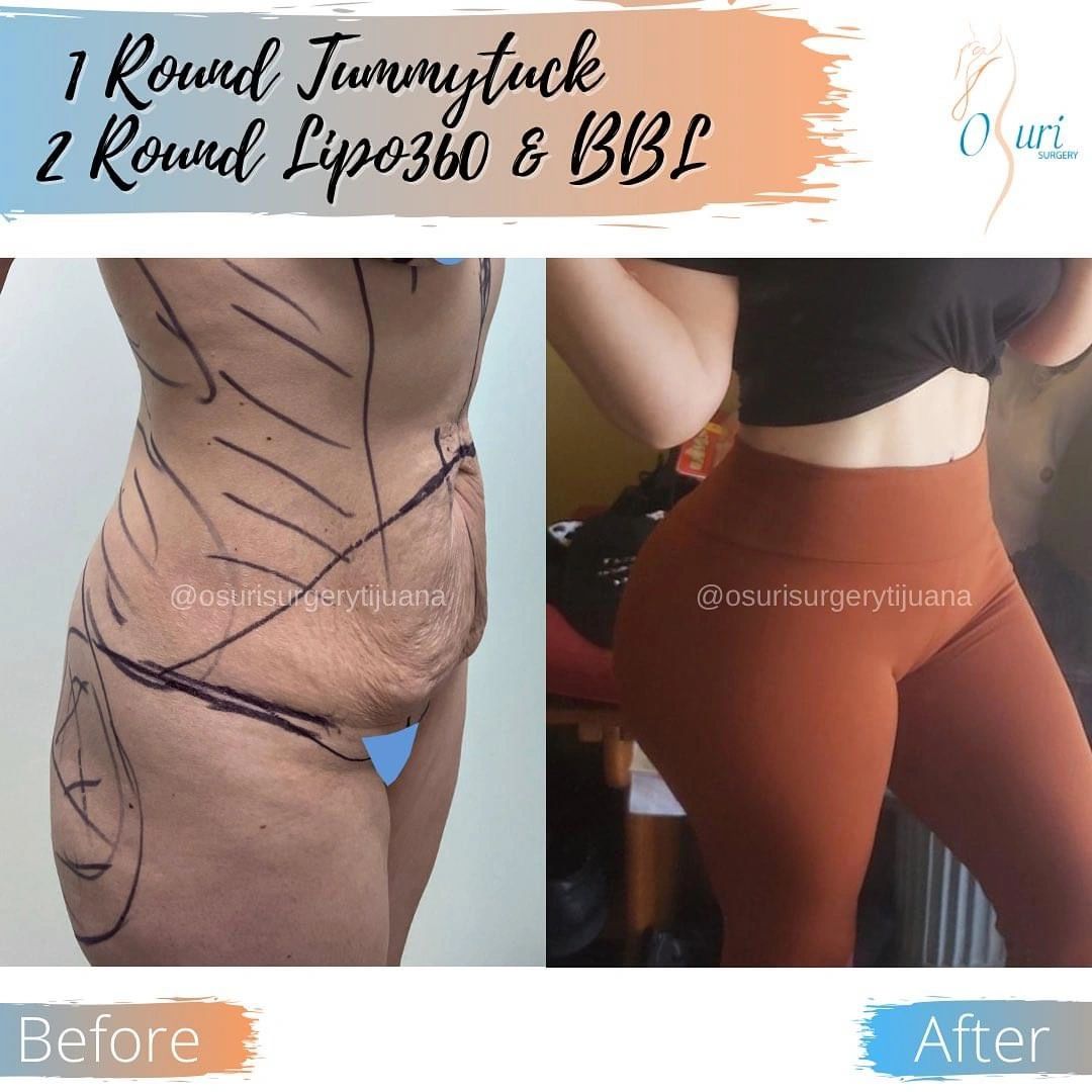 Body transformation before and after cosmetic surgery.