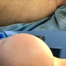 Before and After Image of Buttock Augmentation Surgery.