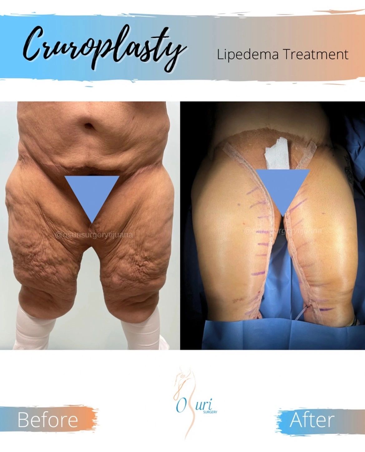 Inner Thigh Tightening and Lifting.