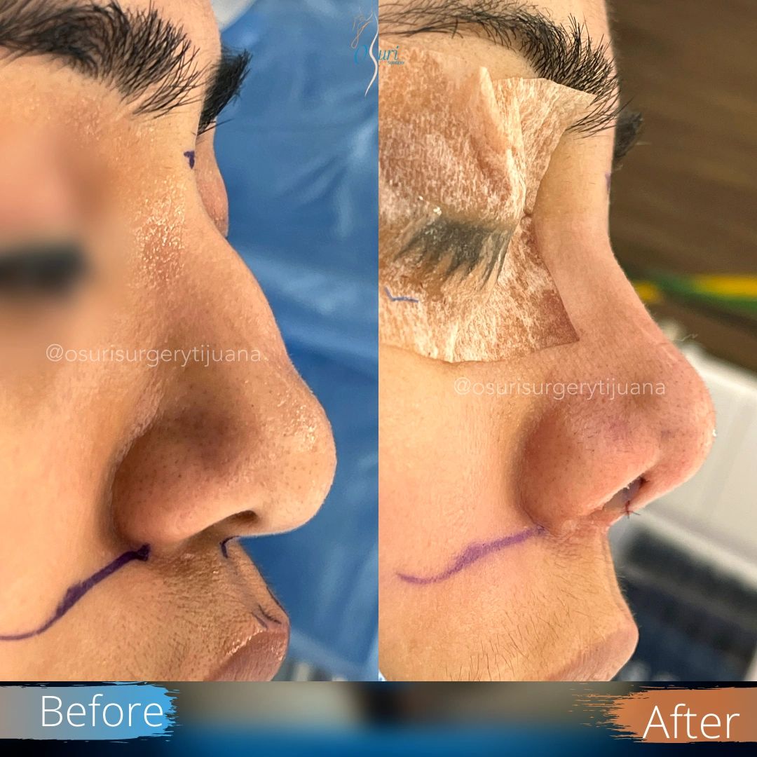 Comparación de perfil facial antes y después de cirugía estética nasal.
