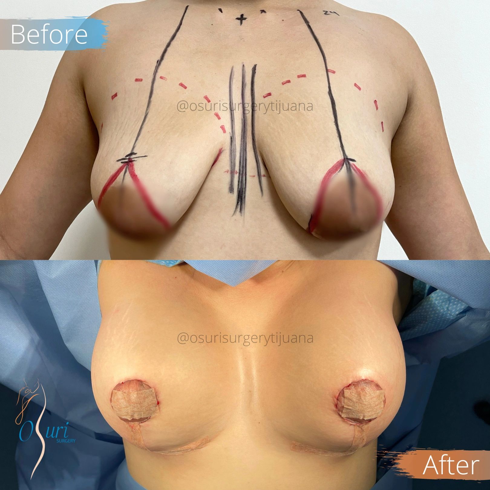 Breast Lift Surgery Showing Preoperative Markings and Postoperative Results.