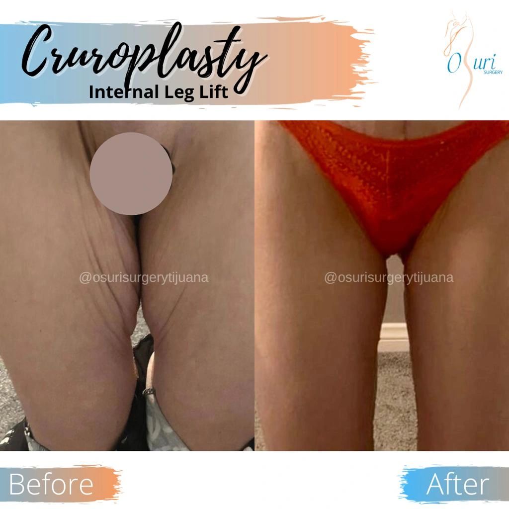 Thigh Lift Results Showing Inner Thigh Tightening and Lifting.