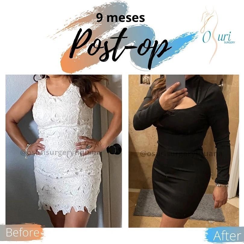 Comparación de cuerpo antes y después de 9 meses post cirugía.