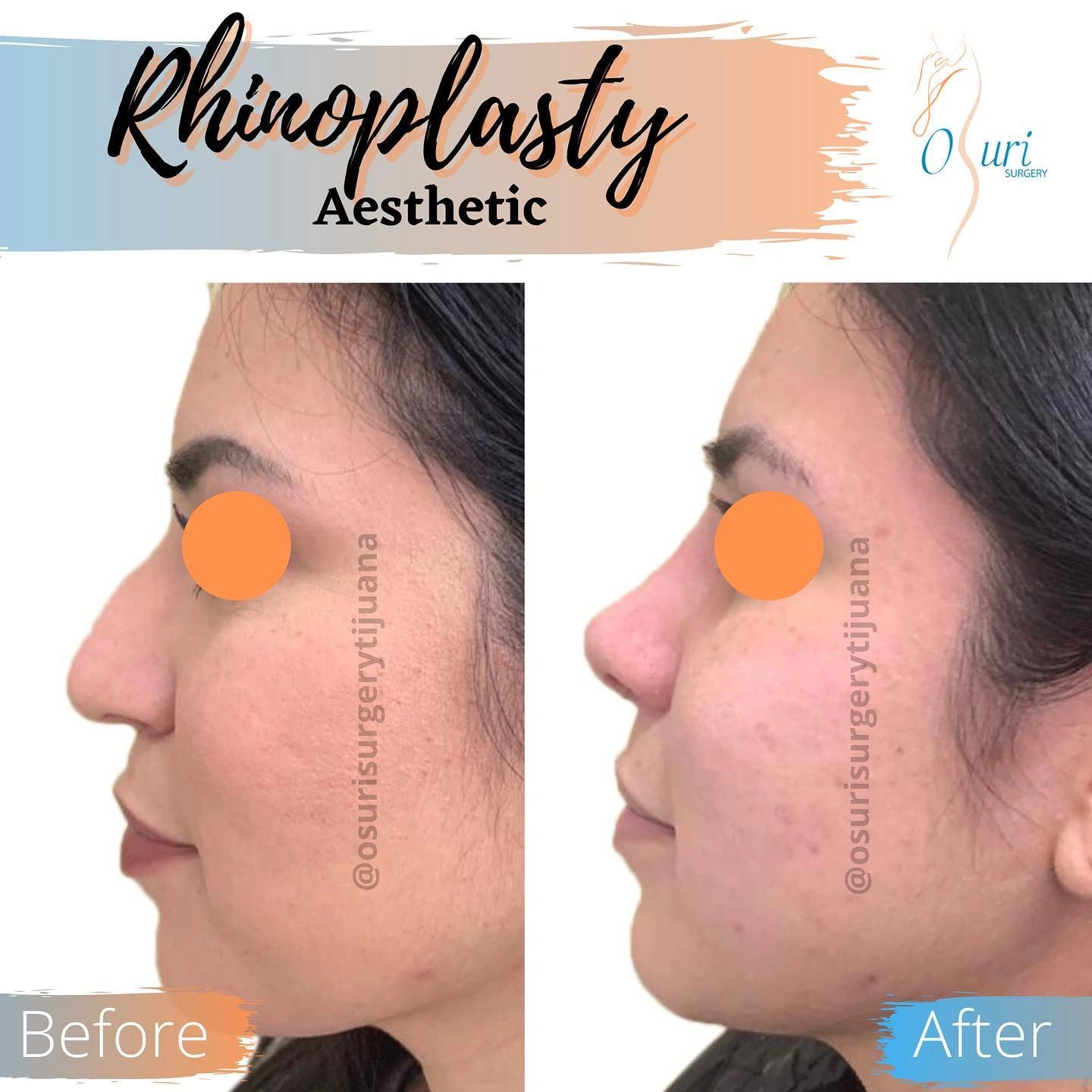 Antes y después de rinoplastia estética en perfil femenino.