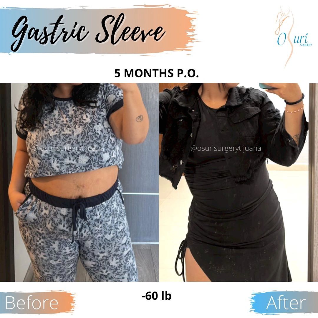 Transformación tras 5 meses de cirugía gástrica.