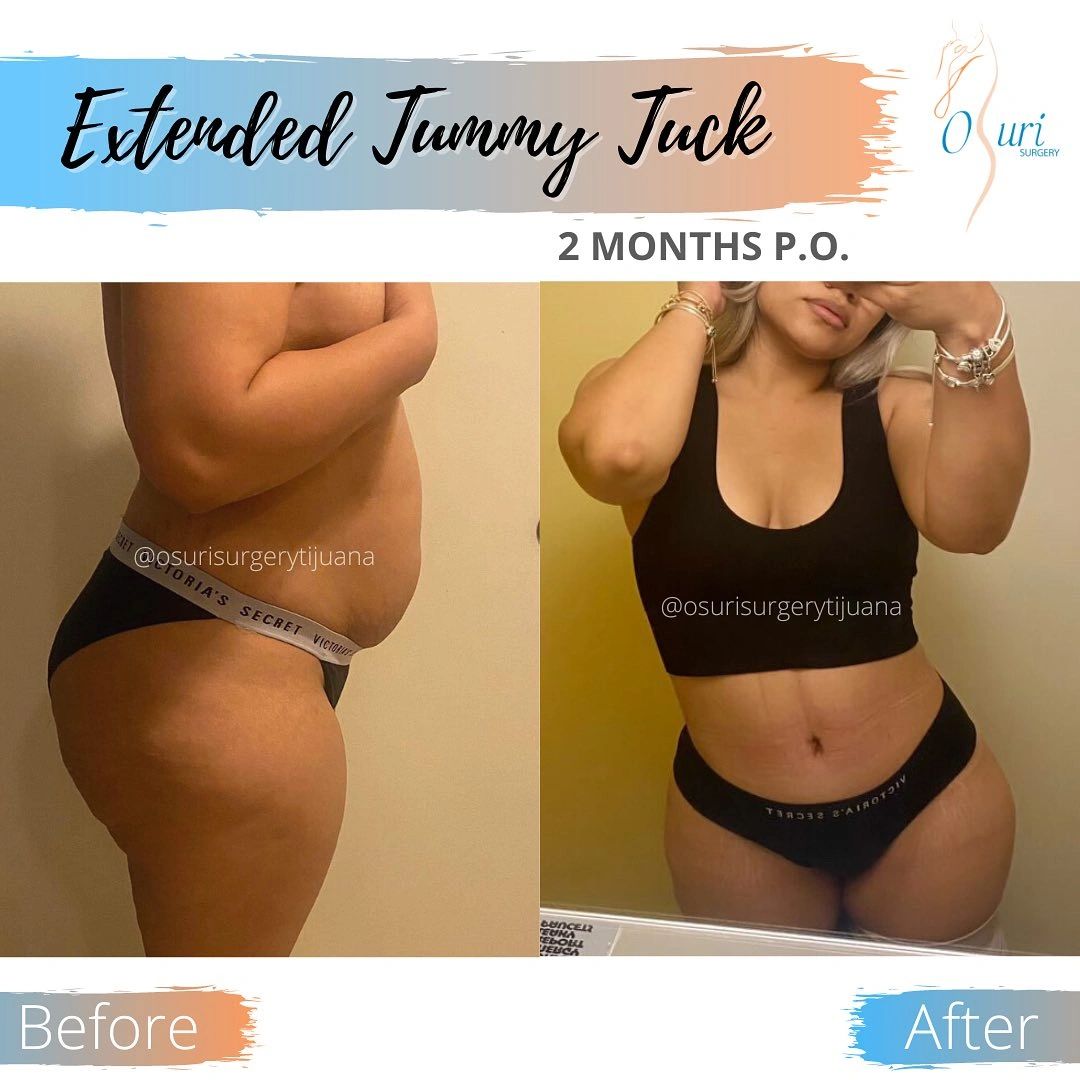 Cambio visible en abdomen tras cirugía estética.