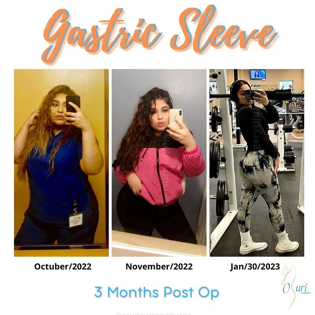 Transformación tras cirugía de manga gástrica en tres meses.