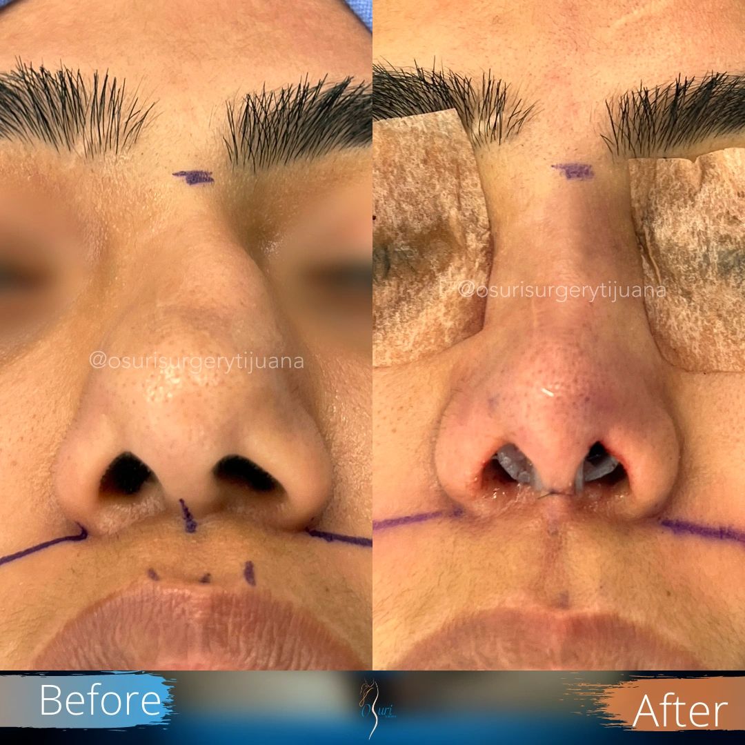 Before-and-after comparison of rhinoplasty showing visible changes in the nostrils.