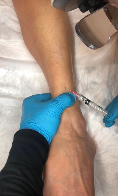 spider vein, sclerotherapy, injections, varicose veins