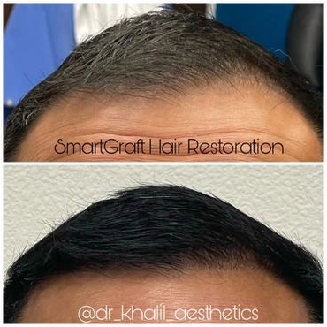 Frontal Hair loss, close-up, after SmartGraft Hair Transplant.