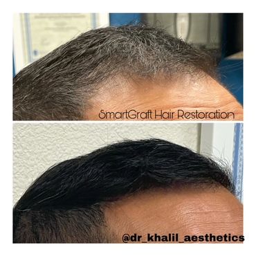 SmartGraft Hair Transplant before and after at 6 months.  Hairline now restored!
