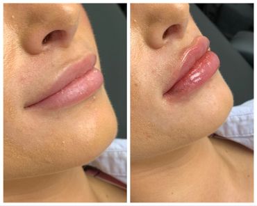 Before and after lip fillers using VERSA hyaluronic acid filler.  