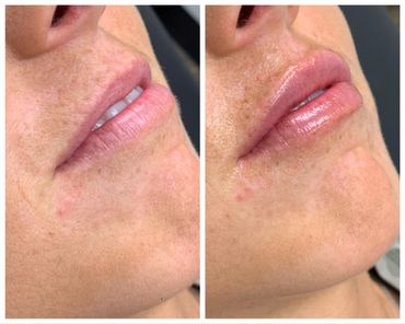 Before and after lip fillers using dermal filler injections such as Restylane Kysse, Versa, Juvederm