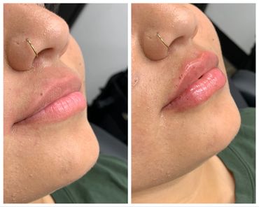 Before and after lip fillers using dermal injection.  Beautiful lips.  