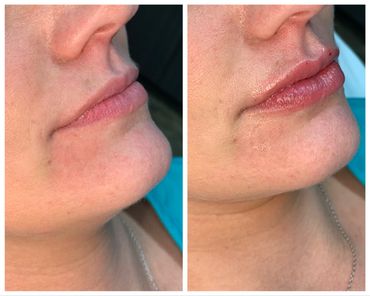 Before and after lip fillers using VERSA hyaluronic acid filler.  