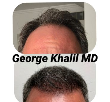 Early Hair Transplant results at 4 months following PRP and SmartGraft Hair Transplant.