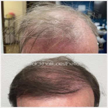 Male Pattern Baldness, addressed using SmartGraft Hair Transplant!