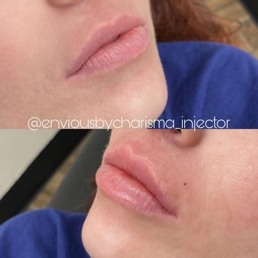 Hyaluronic Acid Filler injections for the Lips!
