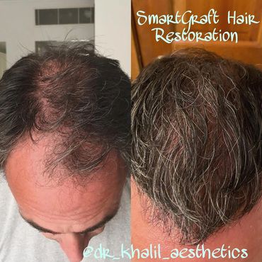 Hairline and Crown Hair Loss restored using SmartGraft Hair Transplant!