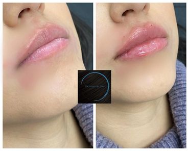 Before and after lip fillers using dermal injection.