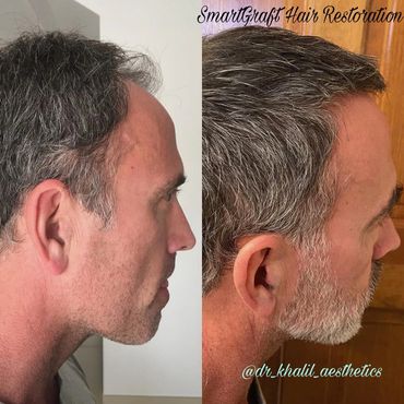 Before and after Hair Transplant results at 6 months.  