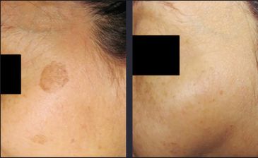 Benign pigmented lesion removal using PicoWay.