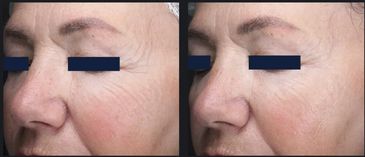Fine lines and wrinkle treatment with Matrix.
