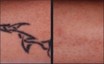 Tattoo removal with PicoWay