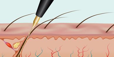 A close up of an electrolysis needles inserted into the hair follicle and surrounding skin anatomy
