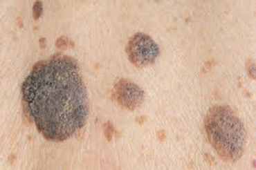 A close up of age spots / seborrheic keratosis