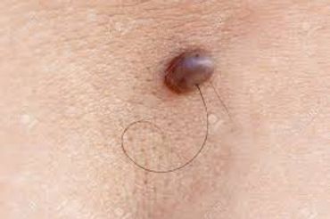 A close up shot of a brown mole with a long hair protruding from it