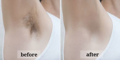 Laser hair removal before and after on ladies underarm hair