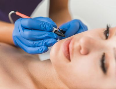 Practitioner wearing blue surgical gloves performing electrolysis permanent hair removal on a female