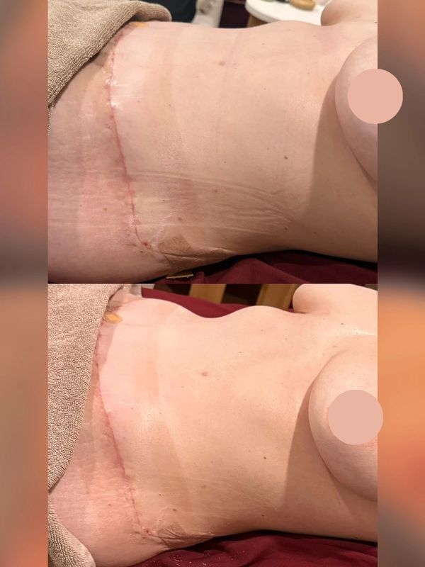 Before and after photos showing healing of a surgical scar on the abdomen.