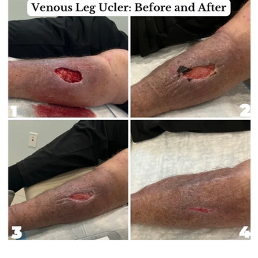 Fall injury with hematoma and venous stasis