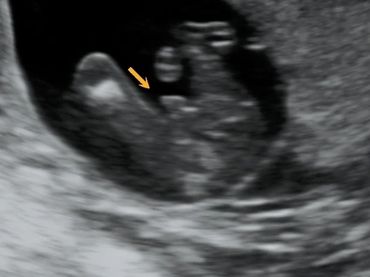 2D Ultrasound picture of gender at 16 weeks pregnant.