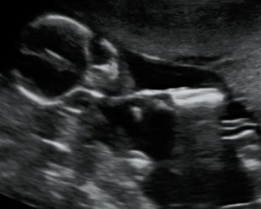 2D Ultrasound front face picture with arm over chin at 16 weeks pregnant.