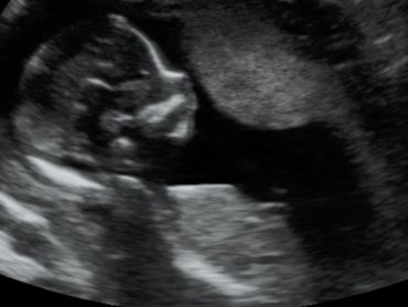 2D Ultrasound profile picture at 16 weeks pregnant.