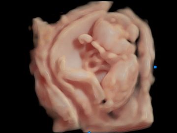 3D ultrasound picture of 2nd trimester baby.