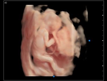 3D Ultrasound in Virtual HD of baby's body with the umbilical cord at 16 weeks pregnant.