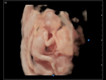 3D Ultrasound in Virtual HD of baby's body with the umbilical cord at 16 weeks pregnant.
