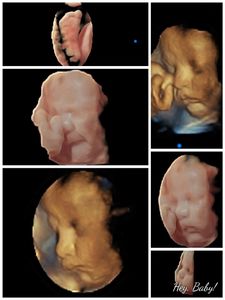 3D ultrasound baby picture