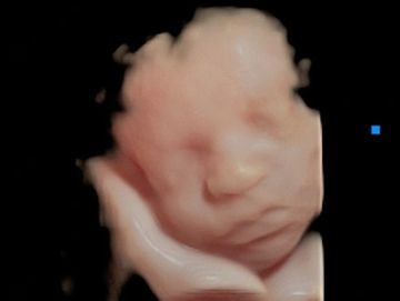 3D ultrasound picture of 3rd trimester baby.
