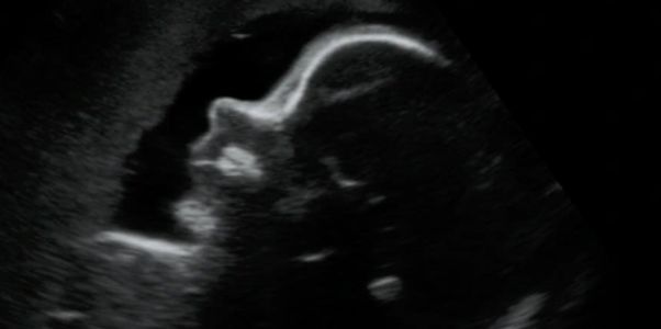 2D ultrasound profile picture of baby in the 3rd trimester.